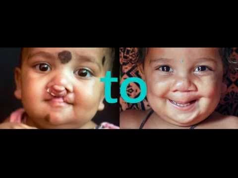 Operation Smile: Cleft to Smile